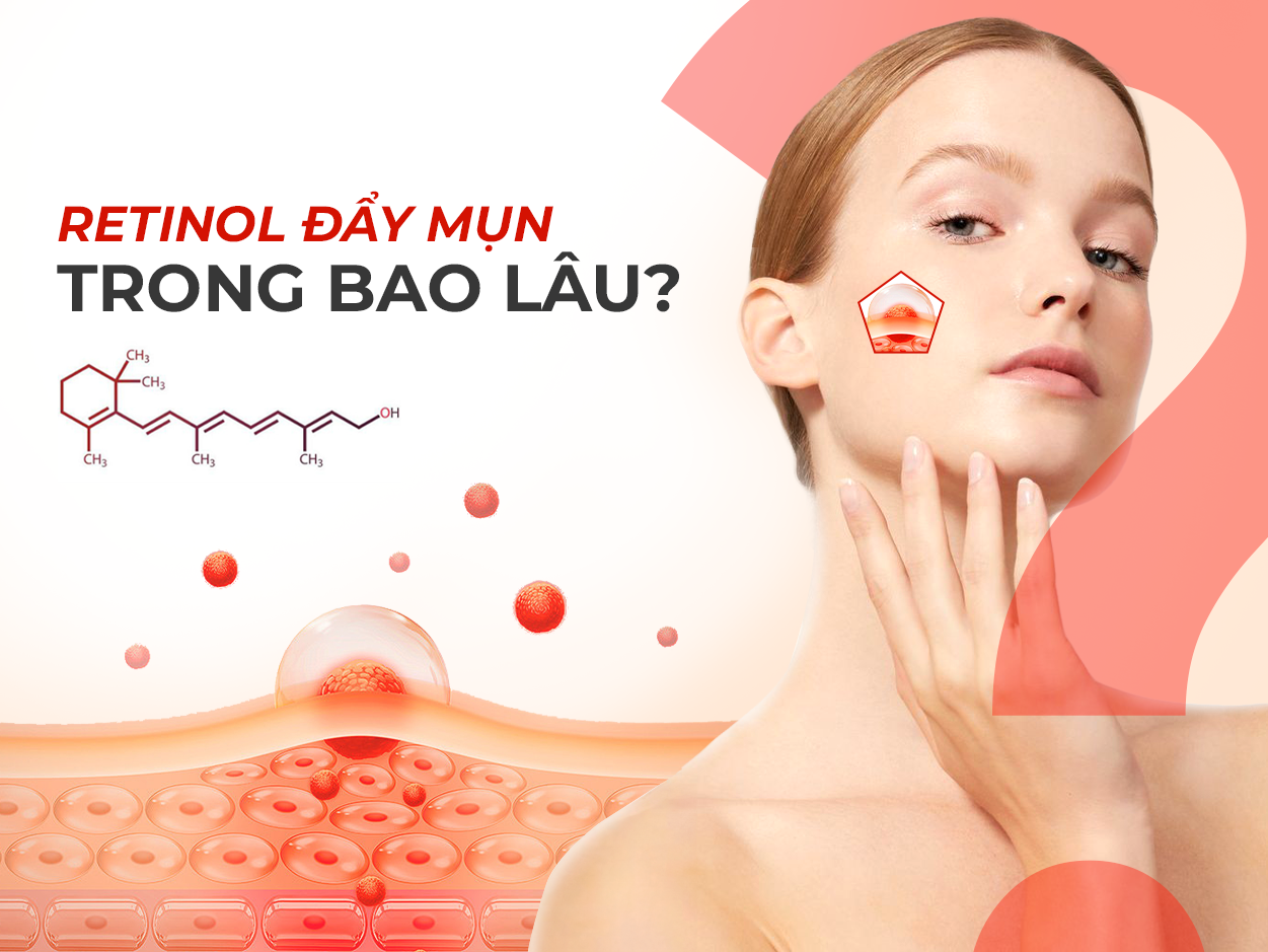 Giải đáp thắc mắc: Retinol đẩy mụn trong bao lâu?