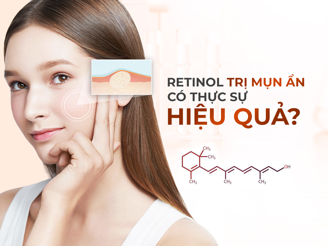 Sử dụng retinol trị mụn ẩn có thực sự hiệu quả không?