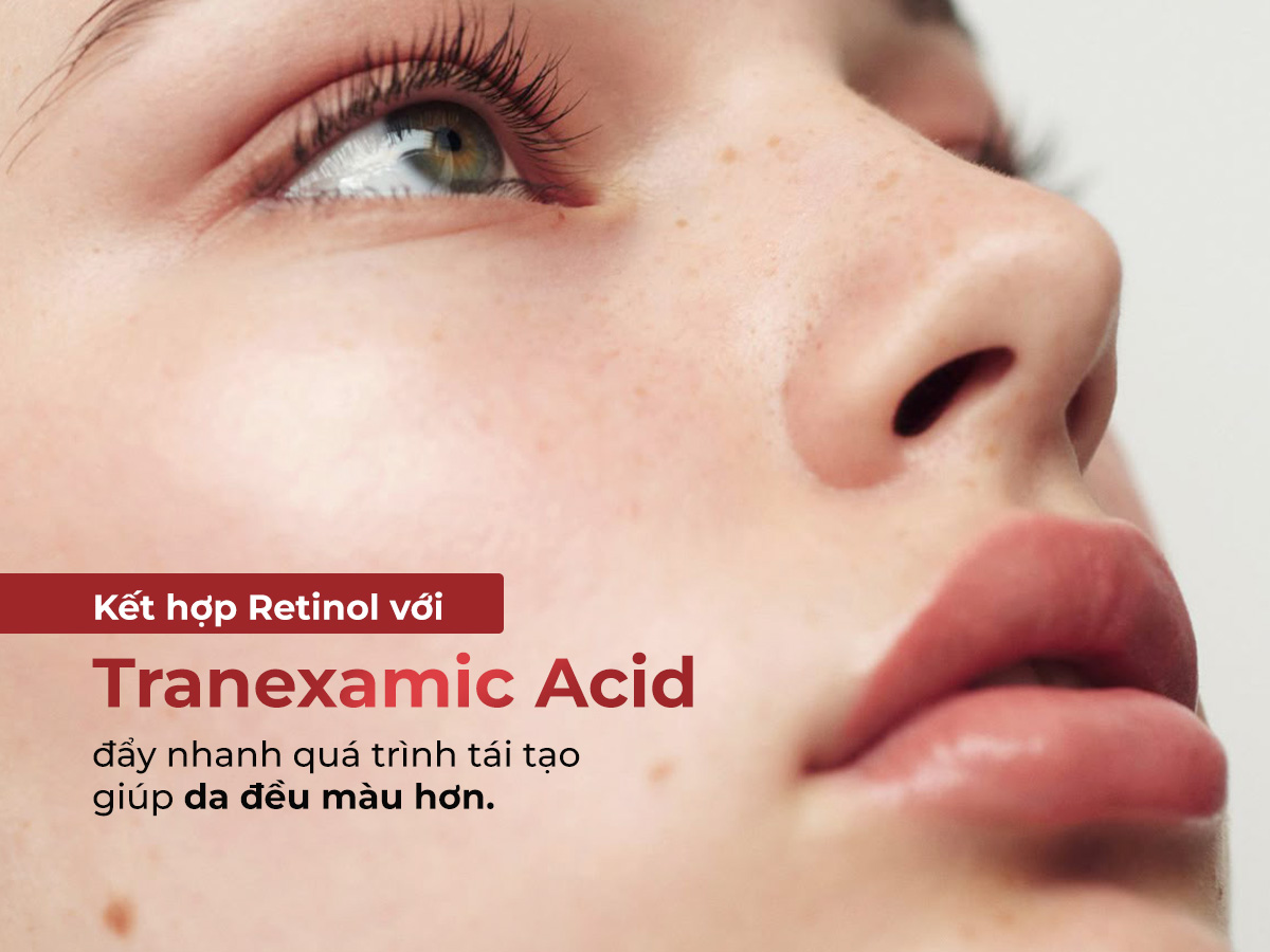 Kết hợp retinol và Tranexamic Acid trị nám