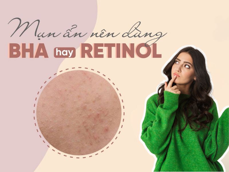 mụn ẩn nên dùng bha hay retinol