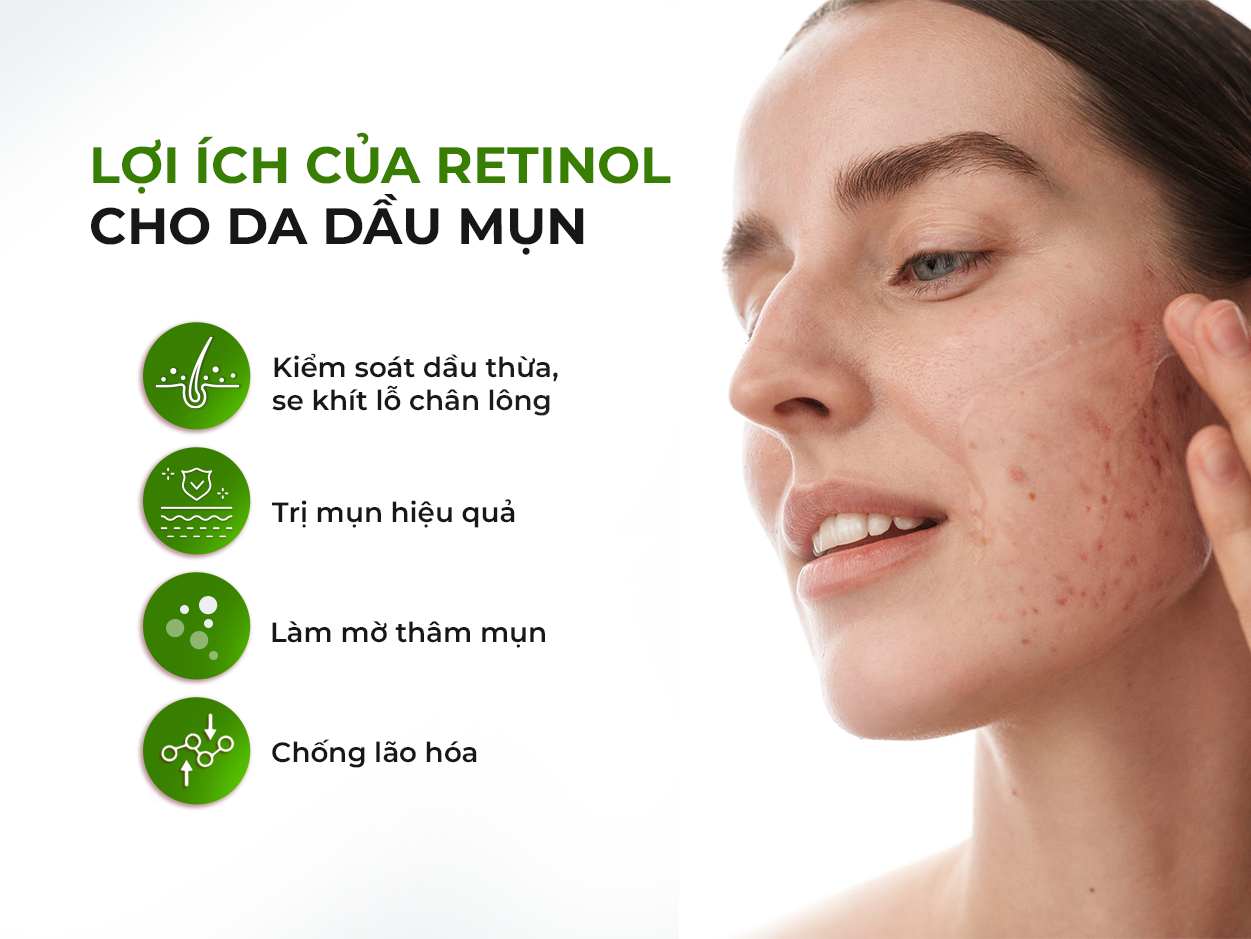 Retinol cho da dầu mụn