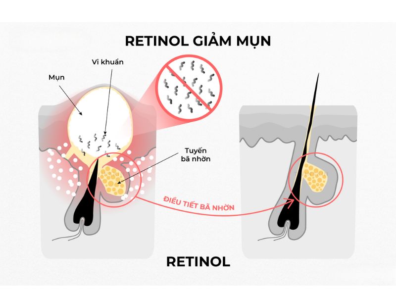 Retinol đẩy mụn trong bao lâu